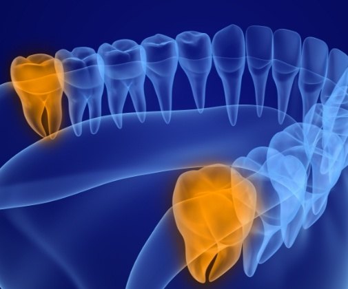 Animated smile with wisdom teeth highlighted