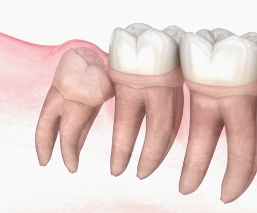 Animated smile with impacted wisdom tooth