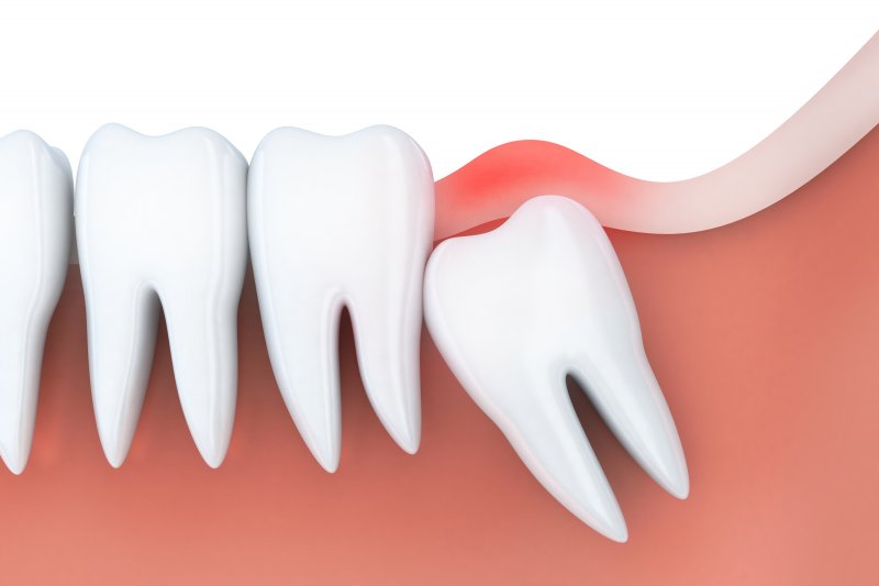 a digital image of an impacted wisdom tooth angled and pressing against healthy, erupted teeth